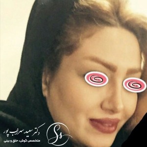 جراحی-بینی-04