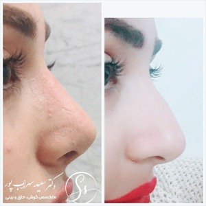 جراحی-بینی-05