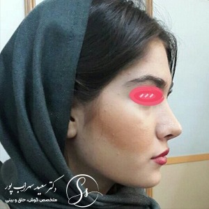 جراحی-بینی-09