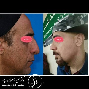 جراحی-بینی-13