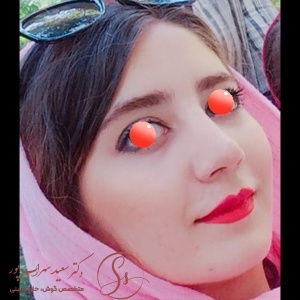 جراحی-بینی-24