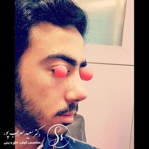 جراحی-بینی-28