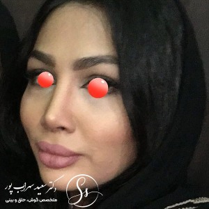 جراحی-بینی-31