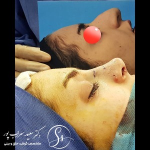 جراحی-بینی-36