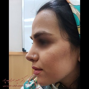 جراحی-بینی-38