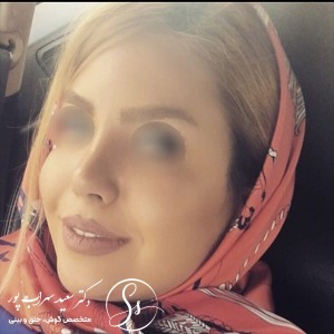 جراحی-بینی-40