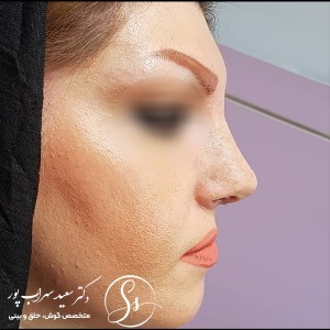 جراحی-بینی-41