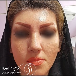 جراحی-بینی-42