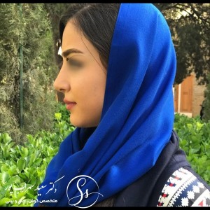 جراحی-بینی-43