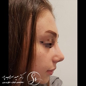 جراحی-بینی-45