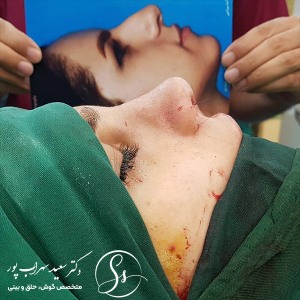 جراحی-بینی-56