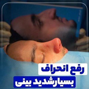 جراحی-بینی-67