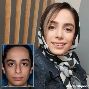 جراحی-بینی-69