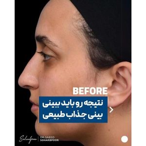 جراحی-بینی-80