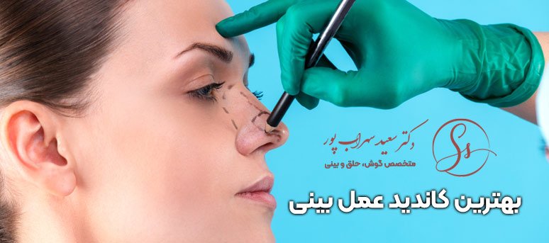 بهترین کاندید عمل بینی چه کسی است