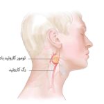 تومور کاروتید بادی و راه درمان با جراحی