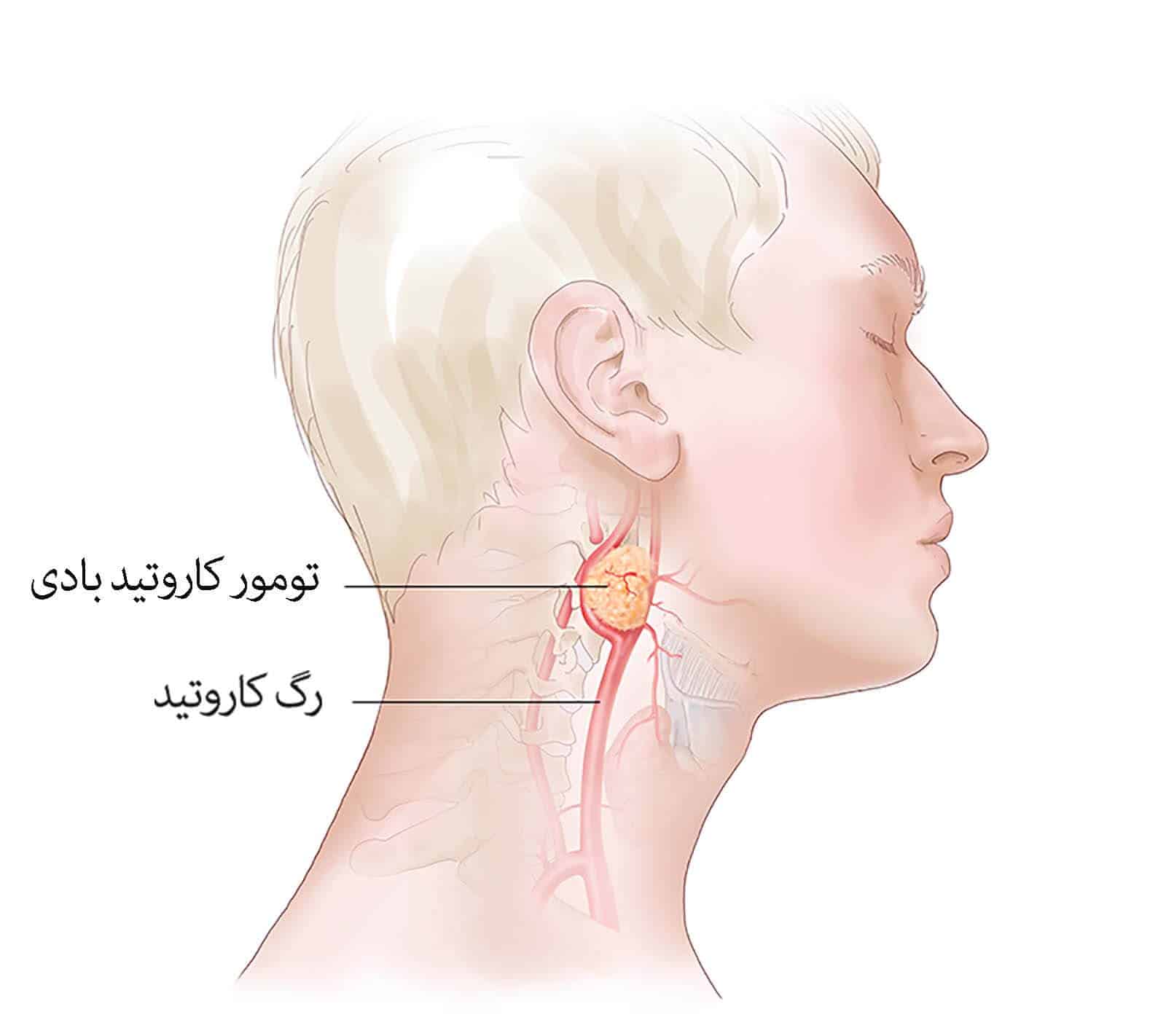 جراحی تومور کاروتید بادی