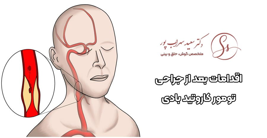 اقدامات بعد از جراحی کاروتید بادی