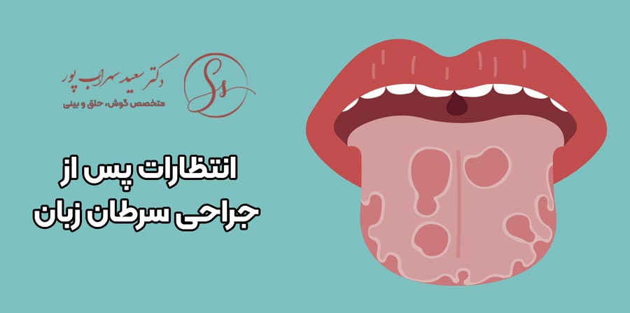انتظارات پس از جراحی سرطان زبان