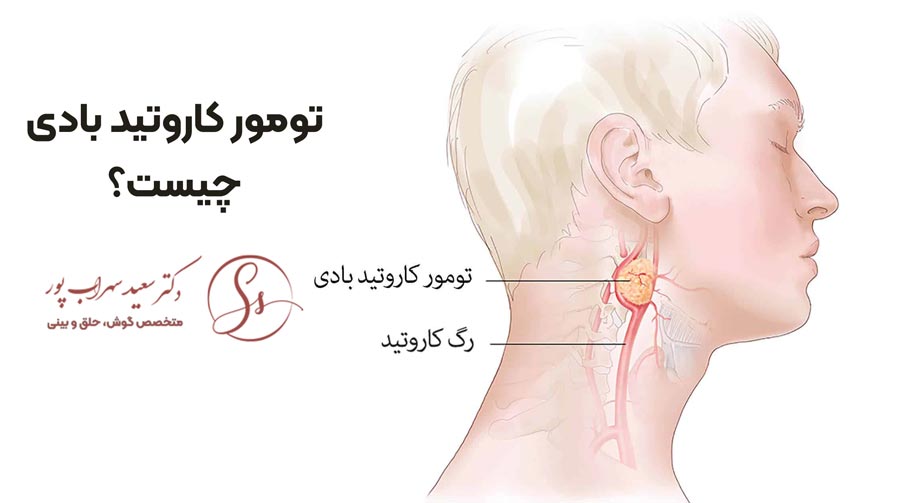 تومور کاروتید بادی - دکتر سعید سهراب پور