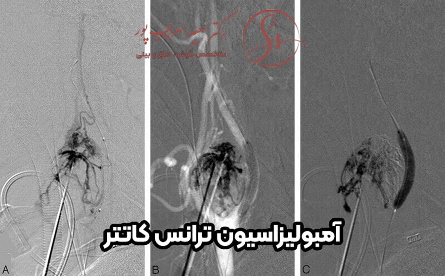 آمبولیزاسیون ترانس کاتتر