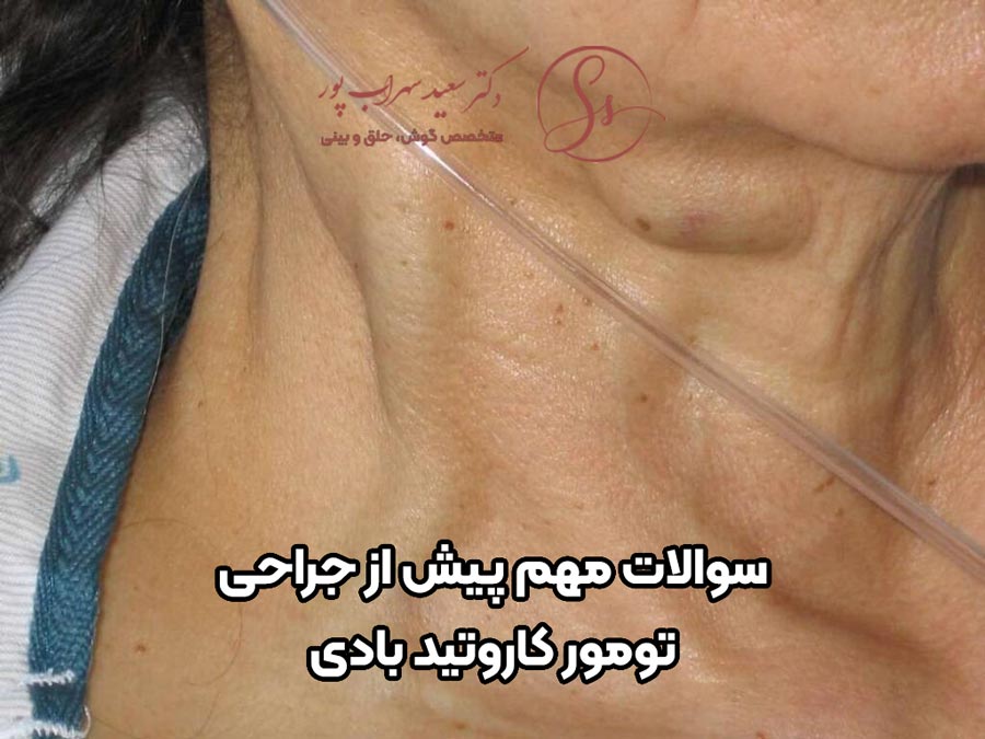 سوالات متداول جراحی کاروتید بادی