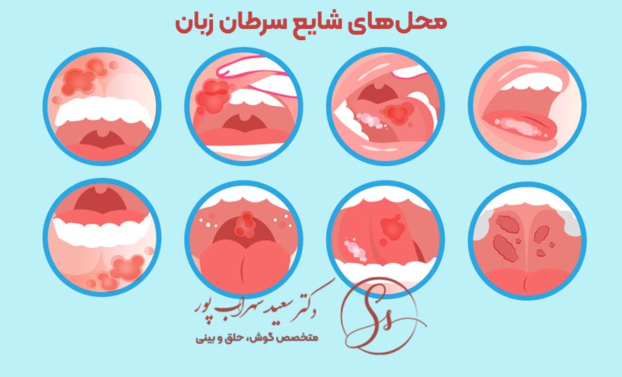 محل های شایع سرطان زبان