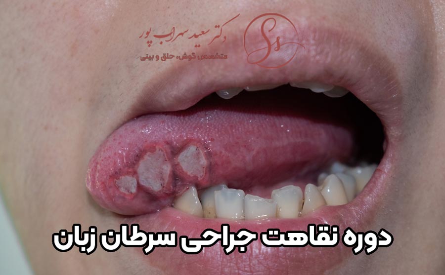دوره نقاهت جراحی سرطان زبان