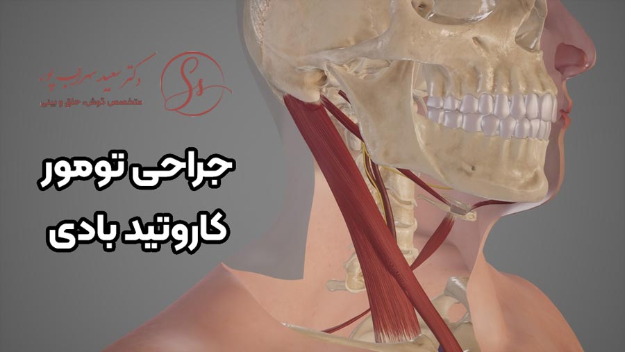 جراحی تومور کاروتید بادی