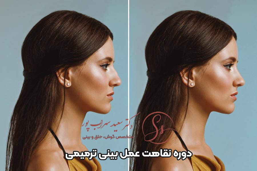 دوره ریکاوری عمل بینی ترمیمی