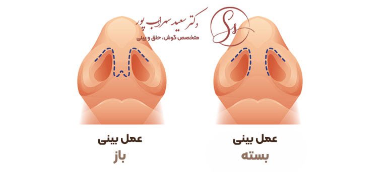 روش های عمل ترمیمی بینی