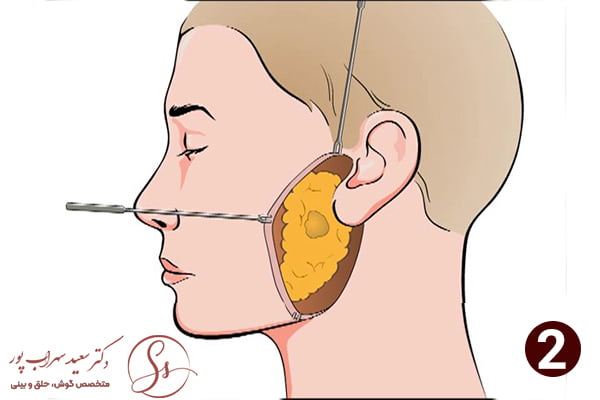 مرحله دوم جراحی غدد بزاقی