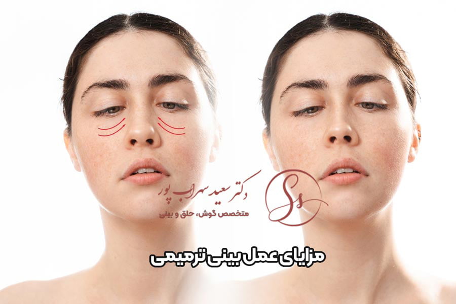 مزایا جراحی ترمیمی بینی