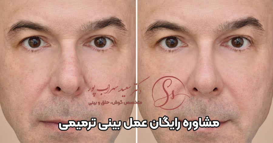 مشاوره عمل بینی ترمیمی
