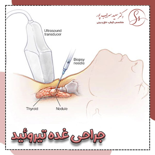 عمل جراحی غده تیروئید - دکتر سهراب پور