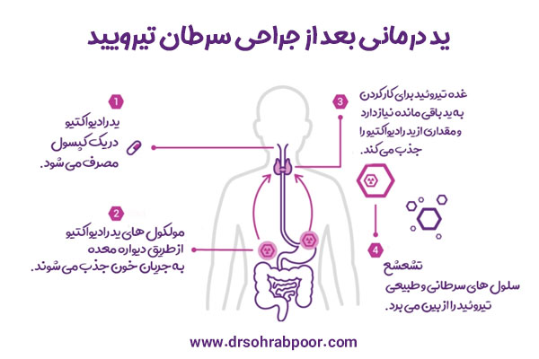 ید درمانی بعد از جراحی سرطان تیرویید + دکتر سعید سهراب پور