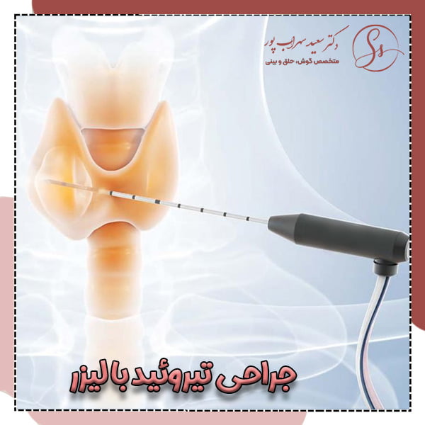 جراحی تیروئید با لیزر - دکتر سهراب پور