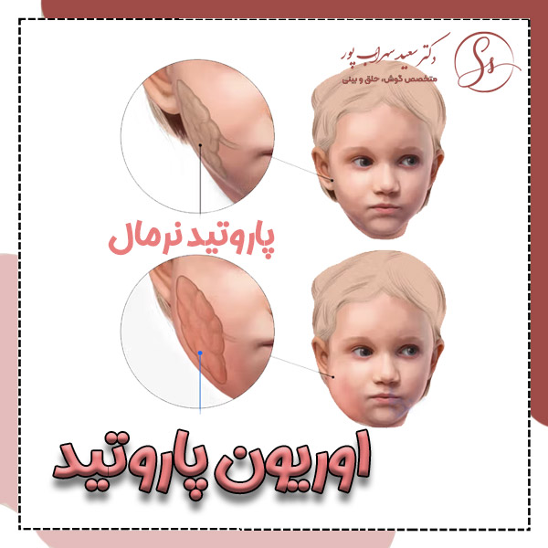 اوریون پاروتید - دکتر سعید سهراب پور