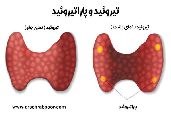 پاراتیروئید + دکتر سعید سهراب پور