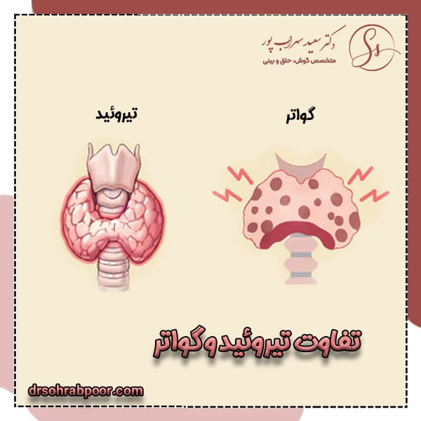 تفاوت تیروئید و گواتر + دکتر سعید سهراب پور