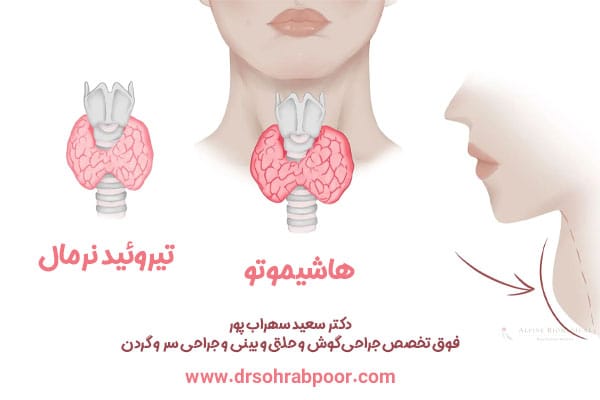 تیروئیدیت هاشیموتو + دکتر سعید سهراب پور 