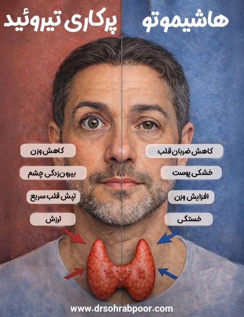 تیروئیدیت هاشیموتو + دکتر سعید سهراب پور 