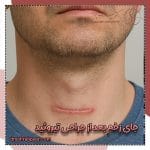 جای زخم بعد از جراحی تیروئید
