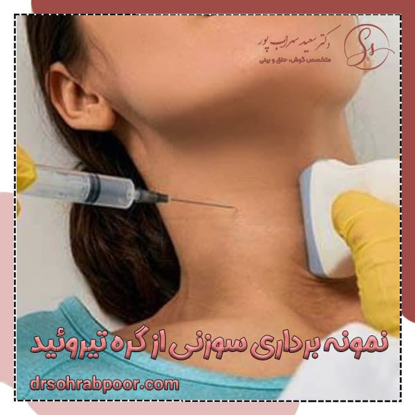 نمونه برداری سوزنی از گره تیروئید + دکتر سعید سهراب پور