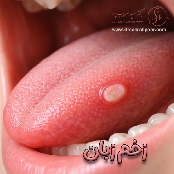 زخم زبان + دکتر سعید سهراب پور