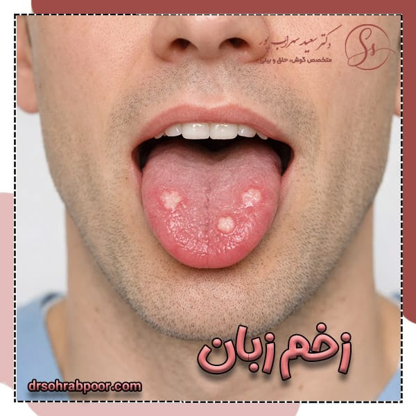 زخم زبان + دکتر سعید سهراب پور