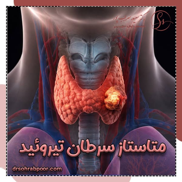 متاستاز سرطان تیروئید + دکتر سعید سهراب پور