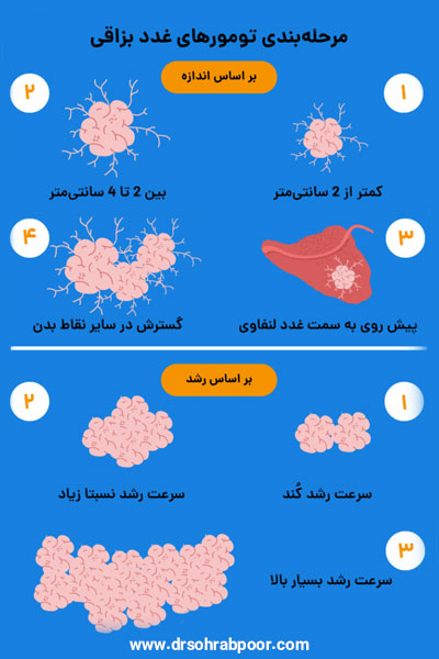 تومور غدد بزاقی پاروتید
