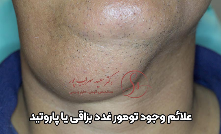علائم وجود تومور پاروتید