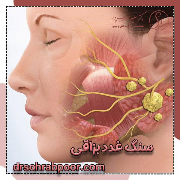 سنگ غدد بزاقی + دکتر سعید سهراب پور